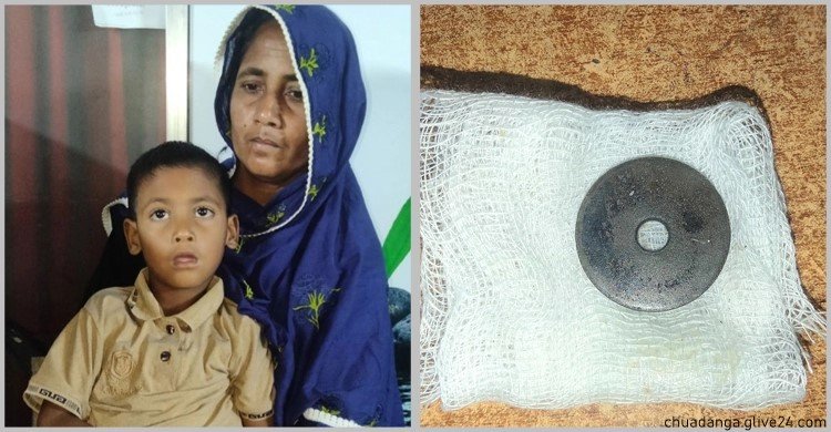 শিশুর গলায় আটকে আছে লোহার ওয়াশার ১৩ দিন পর জানা গেলো